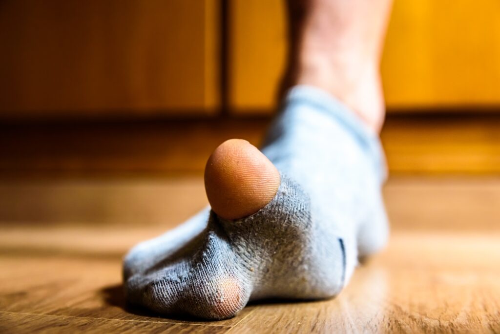 Broken sock with a hole in a man's big toe, concept of poverty during the crisis.